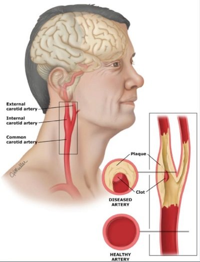 Bệnh động mạch cảnh